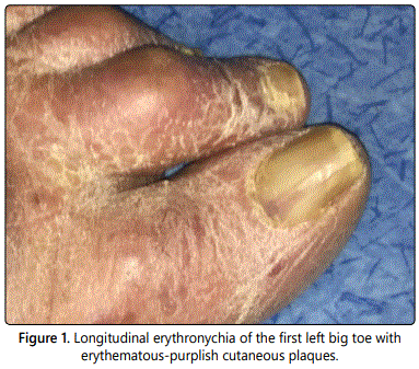 Melanoma of the proximal nail fold mimicking Hutchinson sign | Semantic  Scholar