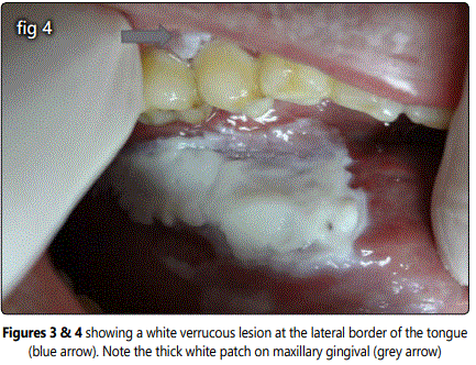 leukoplakia verrucous carcinoma hyperplastic oral keratosis frictional pvl madridge candidiasis lichen squamous examination intraoral diagnosis differential cell including based made